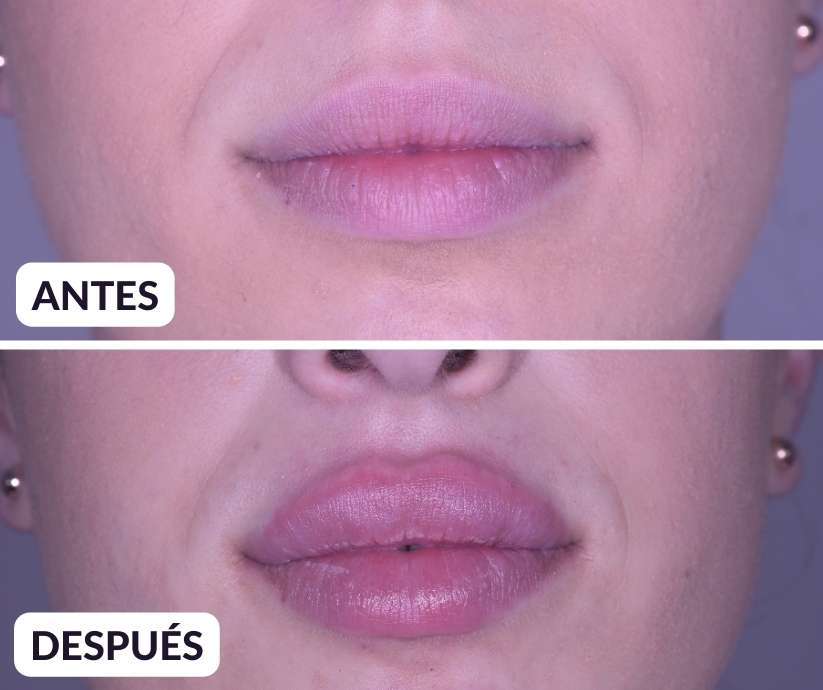 russian lips antes y despues