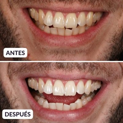 blanqueamiento dental antes y despues